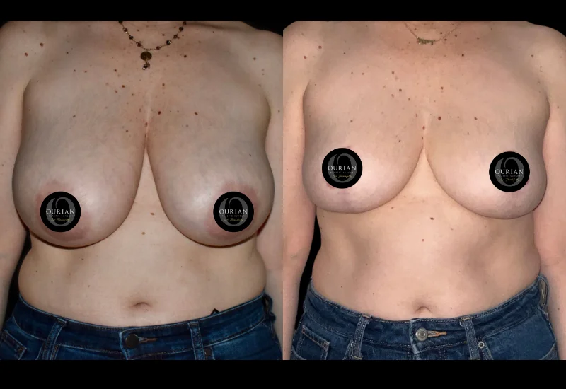 Breast reduction image3